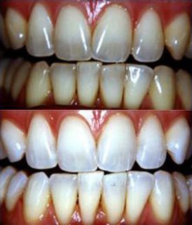   Tooth Teeth Bleaching Kit Teeth Whitening Teeth Whitener Teeth Gels
