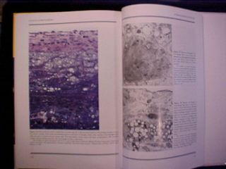 herbert c stary atlas of atherosclerosis progression and regression